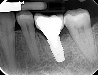 Periapical and Bitewing radiographs of the restored implant after six months in function.