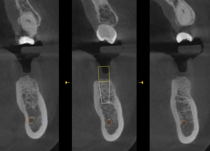 Three Axial Sections (3.0mm split spacing) of #36 region. Central Slice reveals the location of the virtual implant within the grafted ridge.