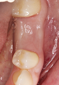Clinical intraoperative photograph showing 4 month postoperative healing,