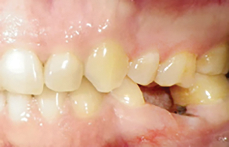 Clinical preoperative photographs of the mandibular left posterior region showing remaining roots of tooth #36.