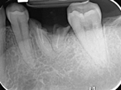 Intraoral Periapical radiograph of tooth #36 and bitewing radiograph of the left posterior region.
