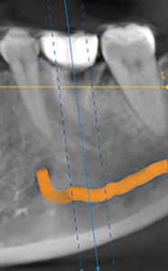 Localized panoramic view from the CBCT which was obtained showing the implant radiographic guide fabricated by the referring dentist.