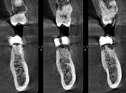 Three Axial Sections (3.0mm split spacing) of tooth #36 which reveal the buccal location of the remaining roots within the alveolar ridge.