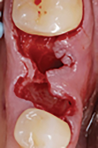 Clinical intraoperative photograph after extraction of #36 and intrasulcular incisions were performed on crestal and buccal aspects of the socket. 