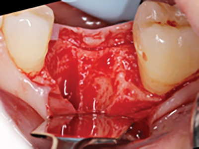 Clinical intraoperative photograph following full thickness buccal flap reflection (Lateral View).