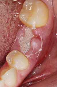 Clinical photographs of the surgical site at the 1-week postoperative visit