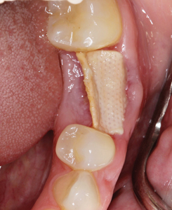 7-week postoperative visit removal of the membrane and presence of deep gingival invagination on the buccal aspect.