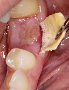 7-week postoperative visit removal of the membrane and presence of deep gingival invagination on the buccal aspect.