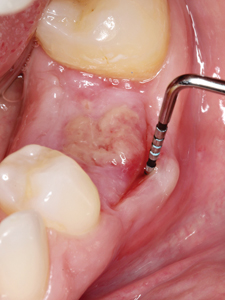 7-week postoperative visit removal of the membrane and presence of deep gingival invagination on the buccal aspect.