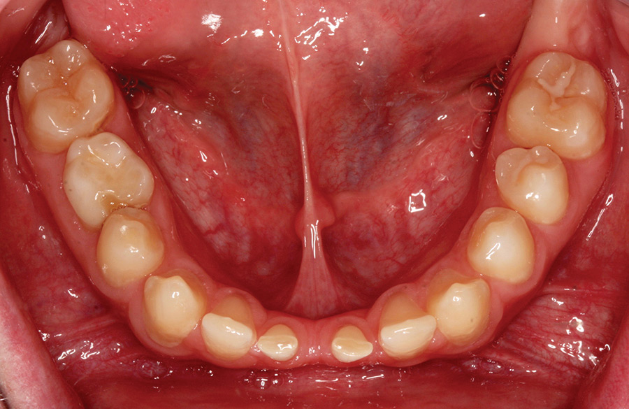 Pre-op occlusal view of mandible. 