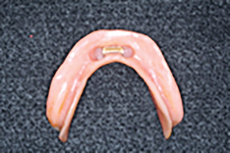 Transition From A Removable To A Fixed ImplantSupported Prosthesis