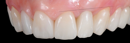 Gingival adaptation around new form and profile. 