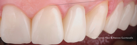 Gingival adaptation around new form and profile. 