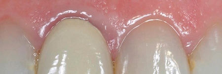 Violation of the biological width and gingival colour changes. 