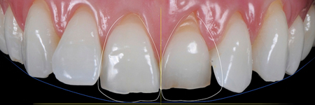 Gingival adaptation around new form and profile with NO-Prep protocol. 