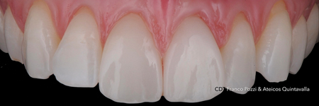 Gingival adaptation around new form and profile with NO-Prep protocol. 