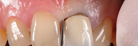 Before starting the procedure, an accurate intrasulcular mapping is made with a periodontal probe in order to assess the level of the epithelial attachment. 