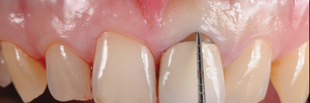 Before starting the procedure, an accurate intrasulcular mapping is made with a periodontal probe in order to assess the level of the epithelial attachment. 