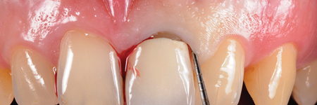 Before starting the procedure, an accurate intrasulcular mapping is made with a periodontal probe in order to assess the level of the epithelial attachment. 