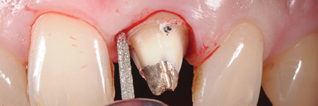 Feather-edge tooth preparation is performed with a flame bur separating the interproximal contact points and following the gingival contour in order to erase the natural tooth undercuts and to enable an adequate fit of the restorations.