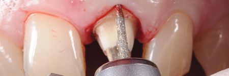 Feather-edge tooth preparation is performed with a flame bur separating the interproximal contact points and following the gingival contour in order to erase the natural tooth undercuts and to enable an adequate fit of the restorations.