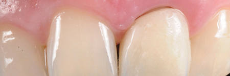 The new temporary crown margin with a new shape and form, is positioned in the sulcus, no deeper than 0.5 to 1 mm, fully respecting the biologic width (controlled invasion of the gingival sulcus). 