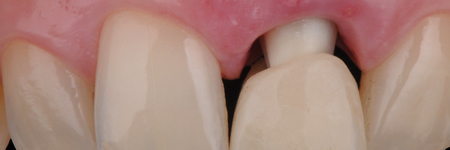 The healing process will determine the reattachment and thickening of the gingival tissue, which will mold and adapt to the new emergence profile. 