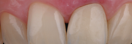 The healing process will determine the reattachment and thickening of the gingival tissue, which will mold and adapt to the new emergence profile. 