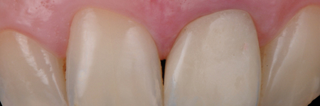 The healing process will determine the reattachment and thickening of the gingival tissue, which will mold and adapt to the new emergence profile. 