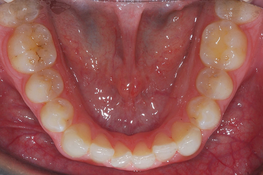 Pre-op mandibular occlusal view.