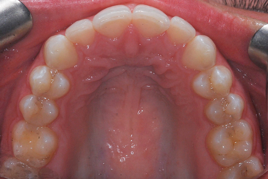 Pre-op maxillary occlusal view.
