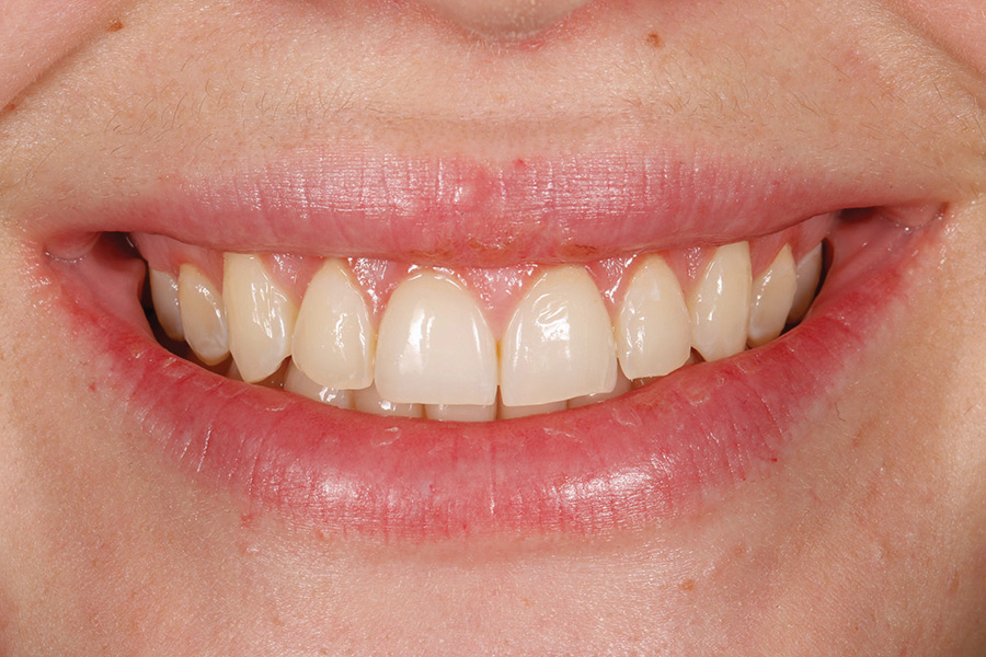 Post periodontal treatment.