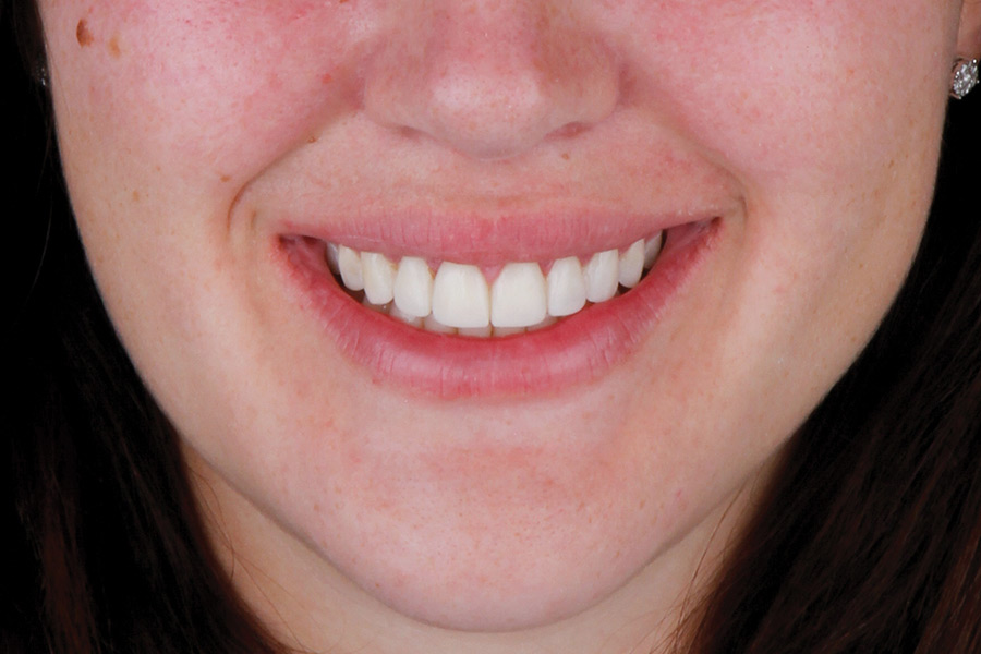 Provisional veneers. 