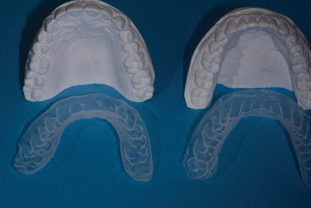 Case Study: Anterior Composite Rehabilitation: A Minimally Invasive ...