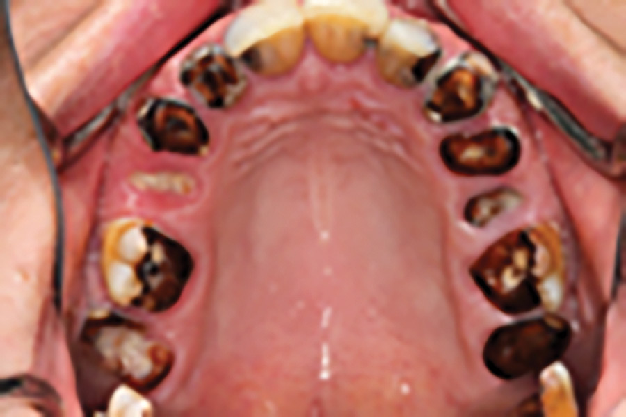 This patient reported that she had neglected her dentition and had stopped smiling. She had the required financial resources to take care of her teeth but was searching for a solution that comprehensively addressed her fear of pain, fear of the complexity of her dental needs and fear of how long it would take for her to resume a normal lifestyle