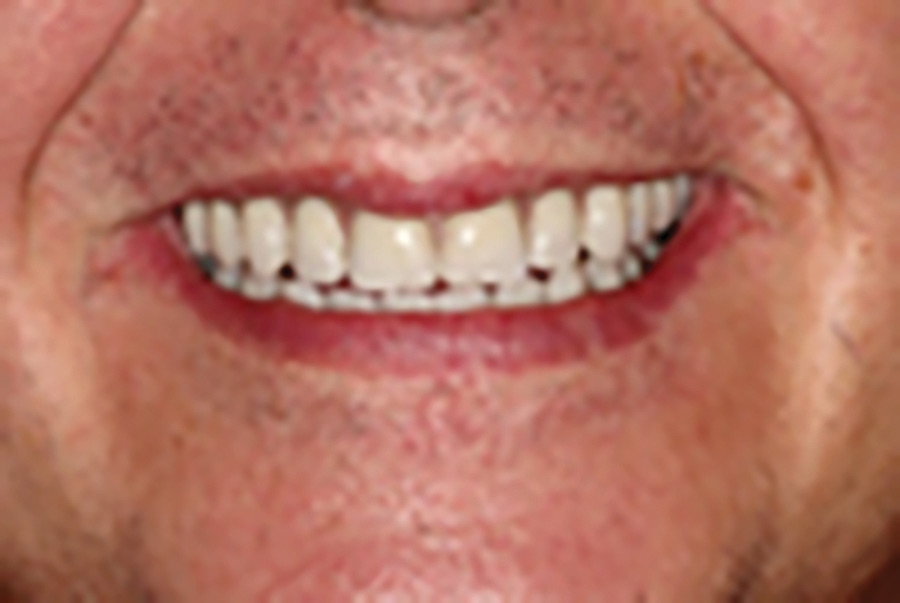 Following a thorough diagnostic work-up, this patient was informed that he was a very good candidate for an implant prosthodontic protocol that addressed his, and his family’s concerns. In one sitting, the remaining teeth were extracted and four implants were placed in each arch to retain fixed screw-retained provisional prostheses. This well supported protocol has been transformative for patients who have been seeking a treatment solution that addresses many of the barriers identified in this article.