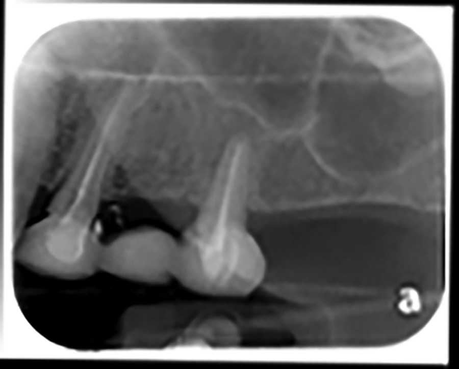 Some patients are reluctant to proceed with augmentation procedures, particularly when it involves the maxillary sinuses. Adopting the concept of tilting dental implants to retain a fixed short span prosthesis allowed this patient to have adequate posterior support without the need for any grafting procedure. 