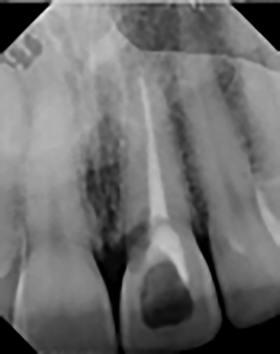 Same-day implant prosthodontic solutions meet the determinants of a patient-centered approach to dental care. This patient was concerned about would replace her # 21 following the extraction of this non-restorable tooth. This site was a good candidate for an Immediate Provisionalization protocol. Tooth #21 was atraumatically extracted, a single implant was immediately placed and restored with a screw-retained provisional. Dental implants specifically designed for this protocol allow patients to transition in a seamless manner with minimal impact to their quality of life.