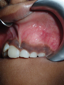 Expansion of the alveolar process, clinical presentation.