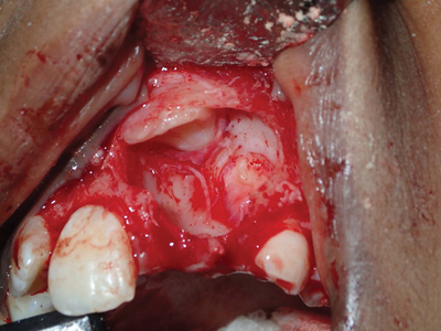 Surgical defect following enucleation of tumour; note severe superior displacement of central incisor.