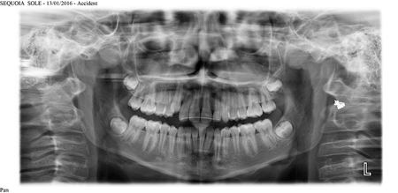 Impacted third molars with no associated pathology, age 13.