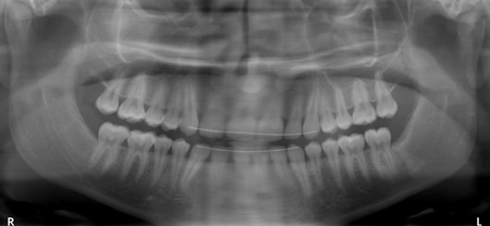 One year follow-up, no evidence of recurrent disease.