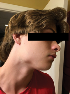 Right-sided extraoral photo