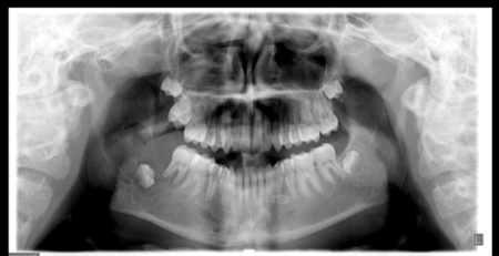 Radiographie panoramique.