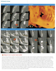 Radiology report with axial and mesiodistal views of right posterior mandible and ramus.