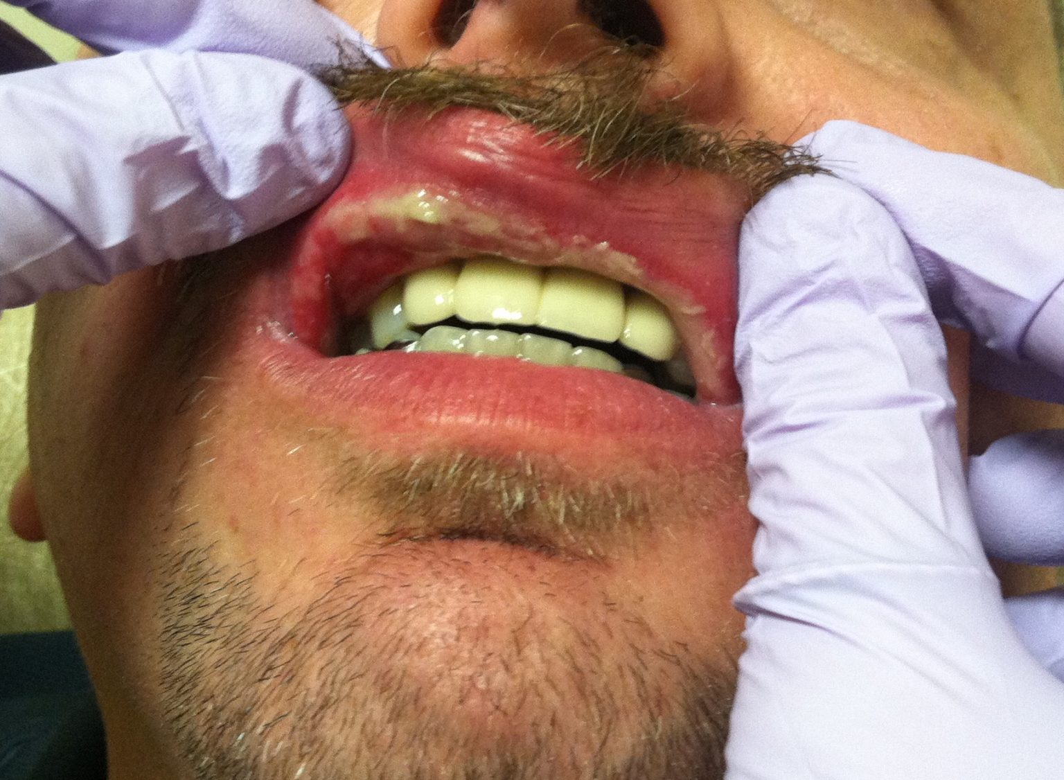 The Use of Photobiomodulation for Oral Mucositis in Patients Receiving