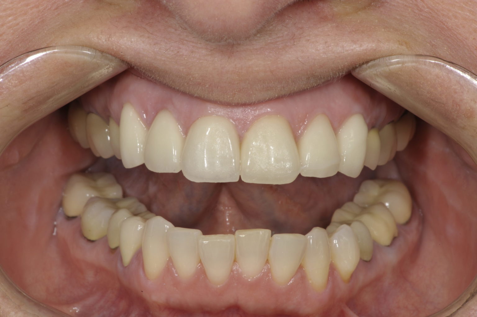 Tooth Front View Photography Essentials in Dentistry - Oral Health Group