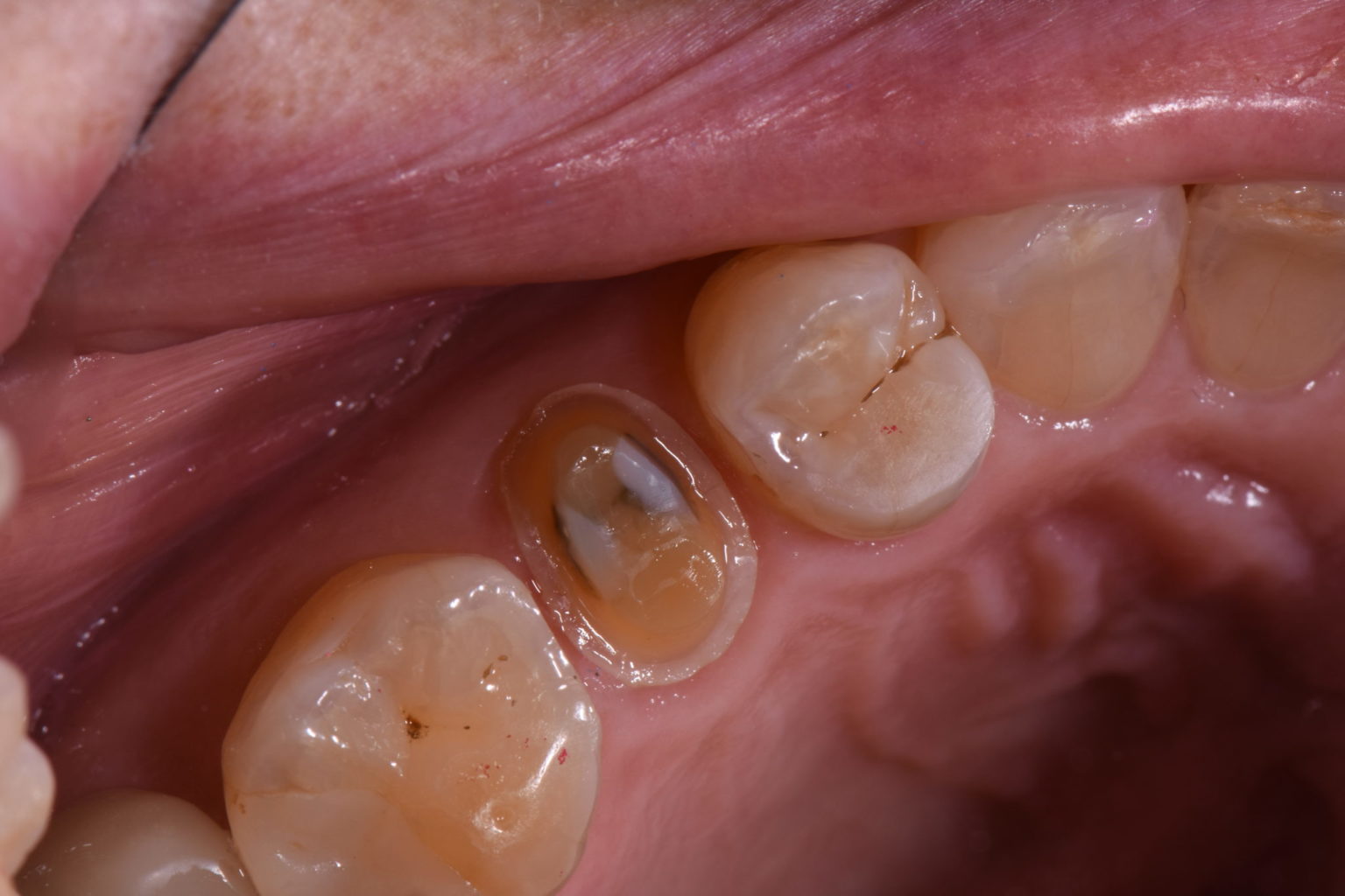 Cementing Crowns with Activa Bioactive Cement Oral Health Group