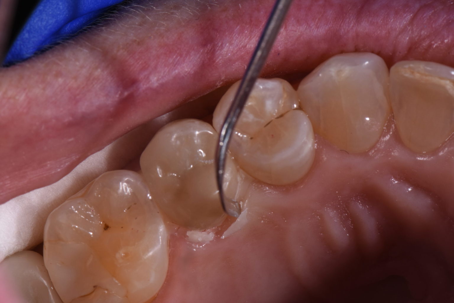 Cementing Crowns with Activa Bioactive Cement Oral Health Group