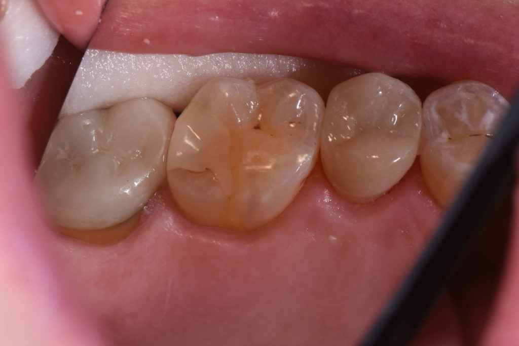 Cementing Crowns with Activa Bioactive Cement Oral Health Group